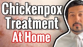 Chickenpox Treatment At Home 2020 [upl. by Arlana]