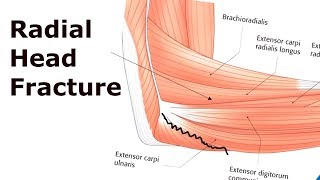 Hip Dislocations and Femoral Head Fractures [upl. by Eannej]