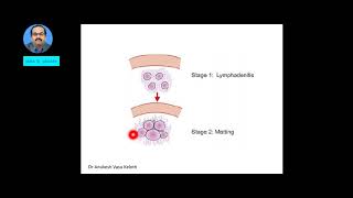 TUBERCULOUS LYMPHADENITIS SCROFULA [upl. by Odnama]