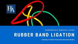 Rubber Band Ligation  Everything You Need to Know about Hemorrhoid Banding [upl. by Remot]