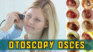 OTOSCOPY OSCEs  PLAB Image Reference [upl. by Flint314]