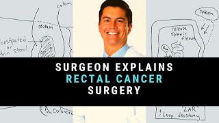 Surgeon Explains Rectal Cancer Surgery [upl. by Bocaj267]