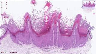 Verruca Vulgaris  Histopathology [upl. by Ardnaet563]