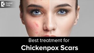 Get rid of skin scars after chickenpox  Dr Rajdeep Mysore  Doctors Circle [upl. by Richie339]