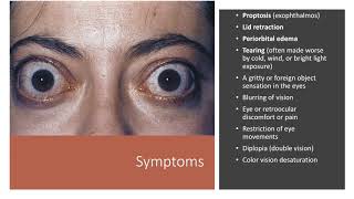 Thyroid Eye Disease [upl. by Nerral859]