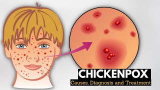 Chickenpox Causes Signs and Symptoms Diagnosis and Treatment [upl. by Buzz868]