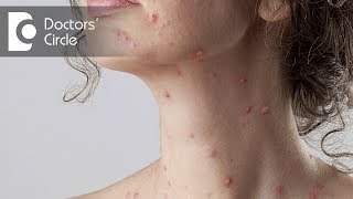 Which medicine can I use to remove chickenpox spots  Dr Vijaya Raghava Reddy [upl. by Hoagland]