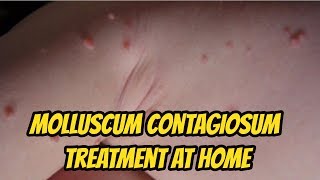 Molluscum contagiosum Treatment At Home [upl. by Aphrodite609]