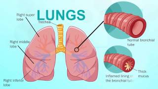 Chronic Bronchitis  Respiratory System [upl. by Connell642]