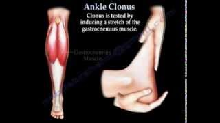 Ankle Clonus  Everything You Need To Know  Dr Nabil Ebraheim [upl. by Ycinuq]