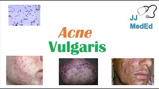 Acne Vulgaris  Causes Pathogenesis Influencing Factors Diagnosis Treatment and Complications [upl. by Laehcor953]