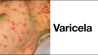 Varicela Contagio Síntomas Tratamiento y Prevención  Enfermedad Exantemática [upl. by Brittne]