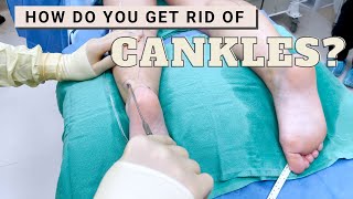 Get Rid of Cankles in 14 Days  10Min Slim Calf Workout No Equipment [upl. by Gertruda]