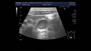 Mesenteric lymphadenitis [upl. by Ariew]