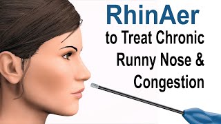 Home Remedies for Allergic Rhinitis  Rhinitis Ayurvedic Treatment  Jiva Ayurveda [upl. by Mehalick876]