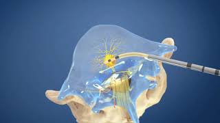 Intracept® Procedure for Chronic Low Back Pain  Cantor Spine Institute [upl. by Llewen]