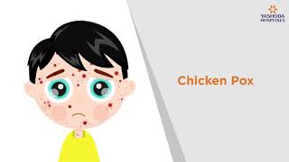 Chicken Pox Symptoms Causes Prevention and Treatment  Yashoda Hospitals [upl. by Sayce]