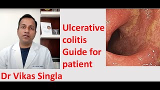 Ulcerative colitis Treatment and Symptoms अल्सरेटिव कोलाइटिस In Hindi Dr Vikas Singla [upl. by Bozovich634]