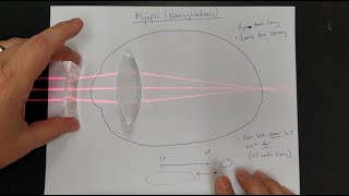 Enhance reading AND distance vision with Cataract Surgery [upl. by Amuh317]