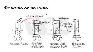 Principles of Fracture Fixation  Orthopedic Basics [upl. by Lamaj]