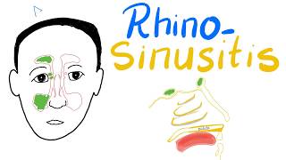 Types of Non Allergic Rhinitis [upl. by Eltsirhc]