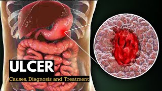 Ulcer Causes Signs and Symptoms Diagnosis and Treatment [upl. by Llerej]