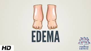 Edema Causes Signs and Symptoms Diagnosis and Treatment [upl. by Adnerol]