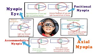 What is Nearsightedness What Causes Myopia [upl. by Hersch555]