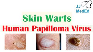 Overview of Skin Warts Verrucae  What Causes Them Who Gets Them  Subtypes and Treatment [upl. by Anayeek]