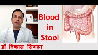 Reason for Blood in Stool  Causes and Treatment in Hindi [upl. by Lynnworth416]