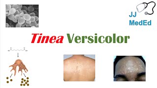 “Fungal Skin Infection of Many Colors” Tinea Versicolor  Pathogenesis Symptoms and Treatment [upl. by Natelson]