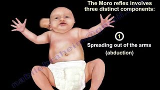 Moro Reflex  Everything You Need To Know  Dr Nabil Ebraheim [upl. by Nawuq]