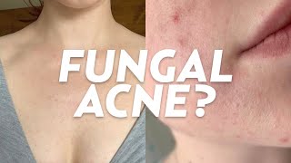 What is Fungal Acne We Discuss Skincare Treatments Causes amp More [upl. by Gabrielson]