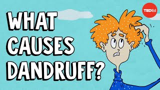 What causes dandruff and how do you get rid of it  Thomas L Dawson [upl. by Ober285]